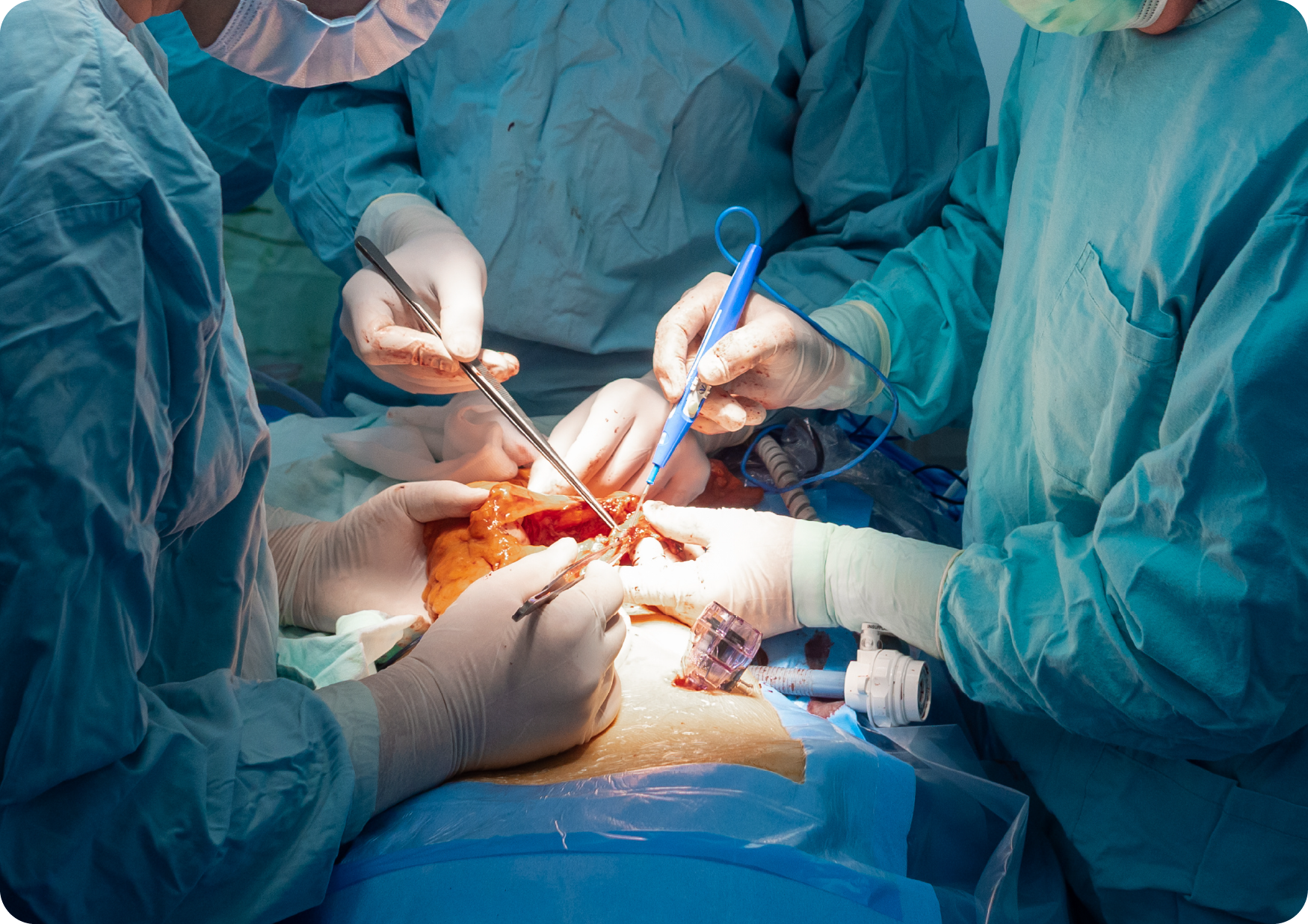 Introduction to Surgical Oncology